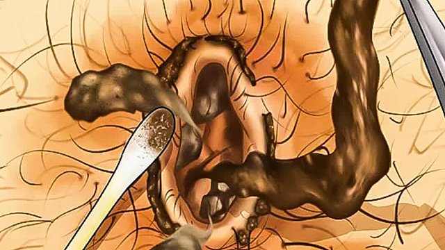 三十年不洗澡的流浪汉，肚脐臭死两只狗，清理过程超解压