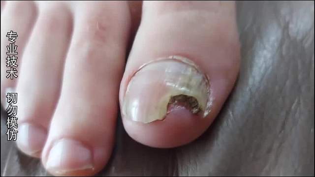 纪录片：这个脚丫子仿佛像是缺了大德！三分之一的脚趾甲毁了！
