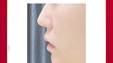 深圳艺星：鼻基底凹陷你了解吗？