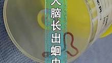 世界首例！人脑中发现8厘米的蛔虫#给孩子看的小知识 #给孩子看世界 