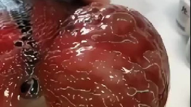 医生：好了，记得一星期不能碰水