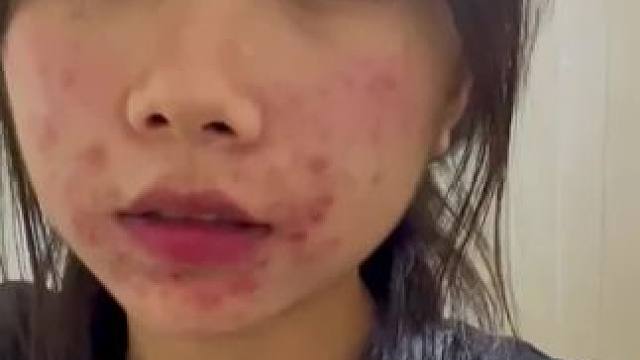 #告别痘痘肌 #痘痘好了 #前后对比