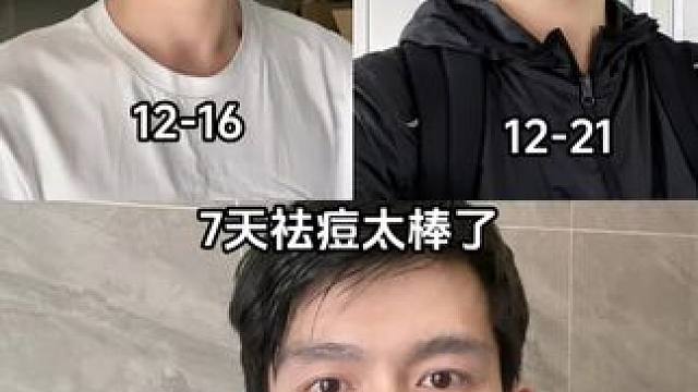 #告别痘痘肌 #拯救痘痘肌 #痘痘好了 #前后对比