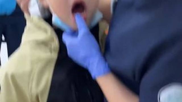 牙医给小孩哥徒手拔牙，手速太快都没看清楚怎么掉的。#原谅我不厚道的笑了 #拔牙不过三秒