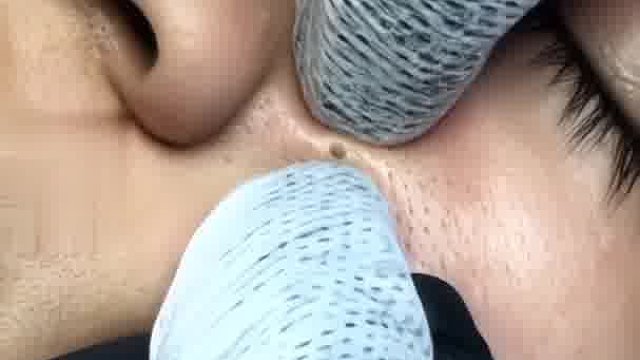 一挤一搓解决黑头