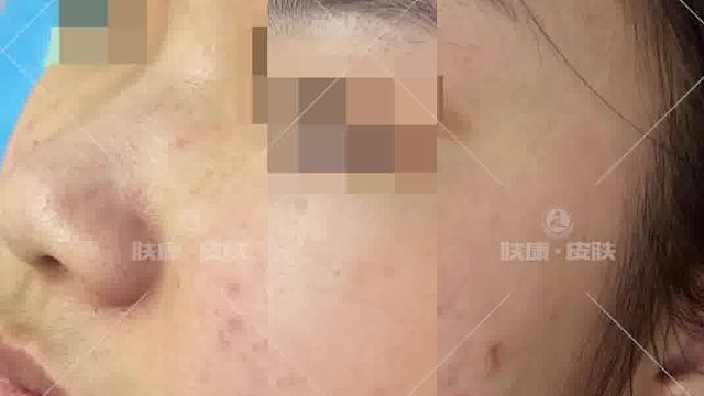 肤康科学有效的改善痤疮，改善肌肤