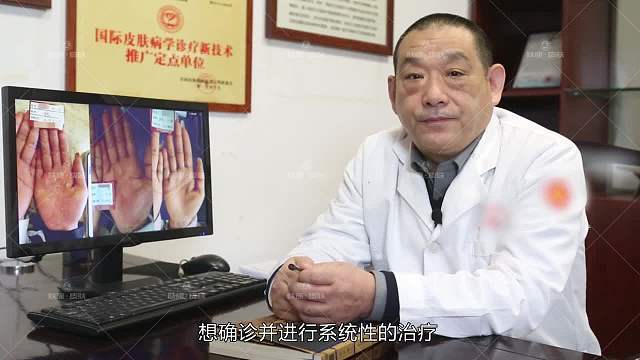 肤康医生概述：手部湿疹患者康复过程。