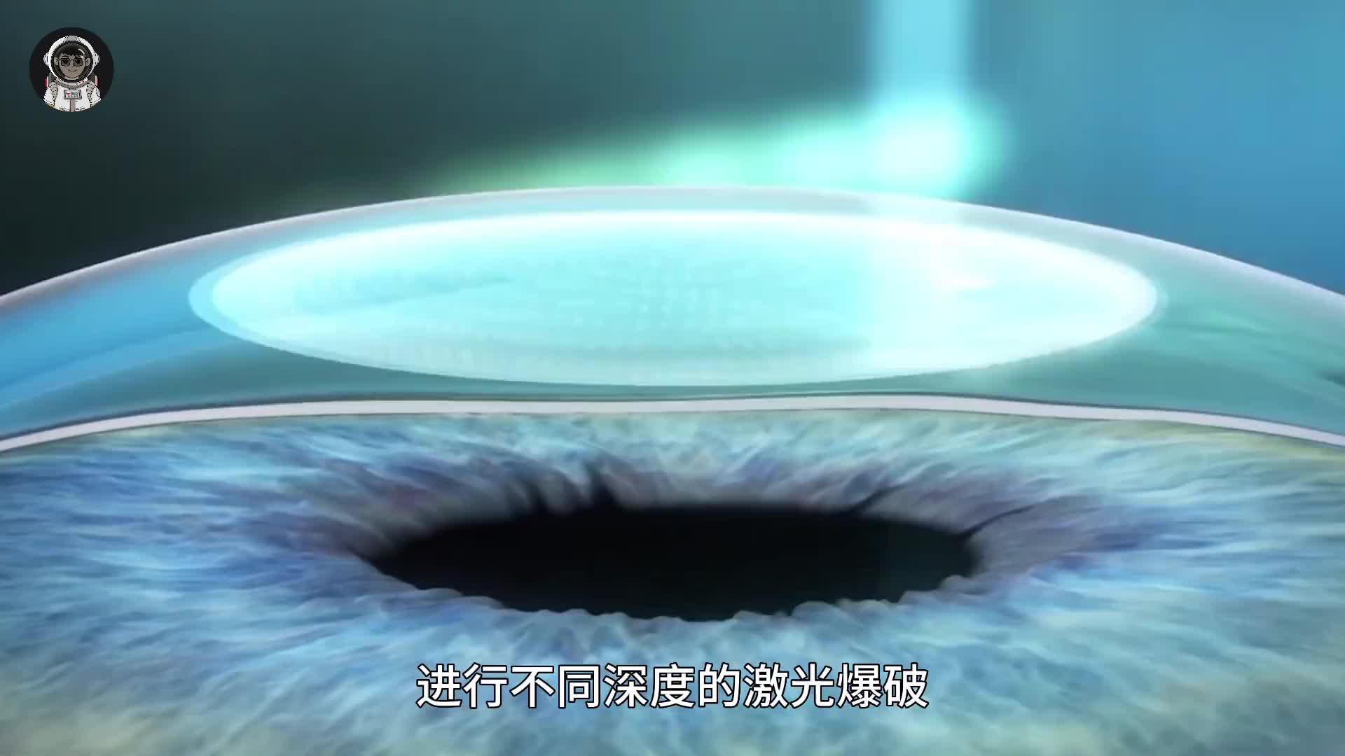 152. 能让你摘下眼镜的近视手术为什么这么贵？