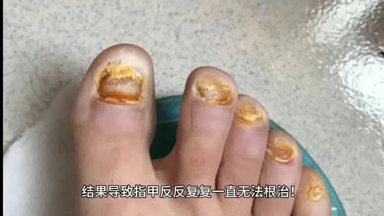 灰指甲如何根治不反复？