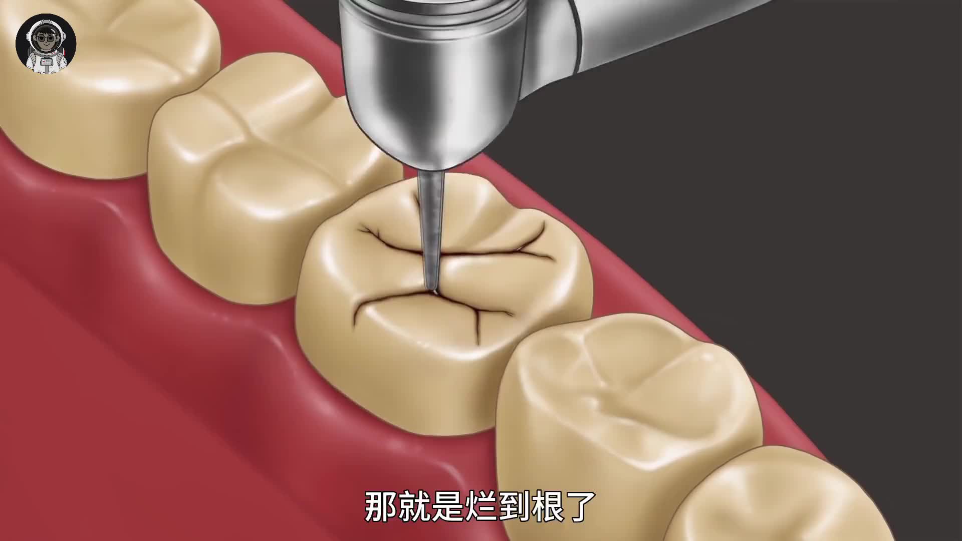166. 你牙齿上刷不掉的黑线究竟是什么，钻开后竟然如此可怕