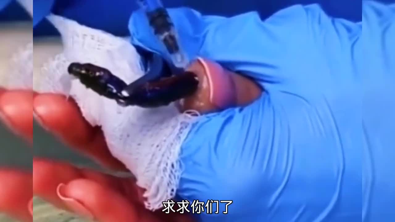 手指头里竟然能长出这么长的虫子