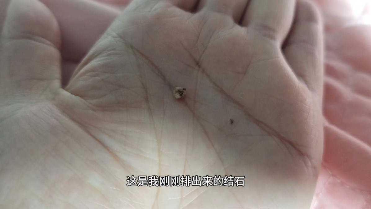 兄弟们，我结石用这方法终于排出来了