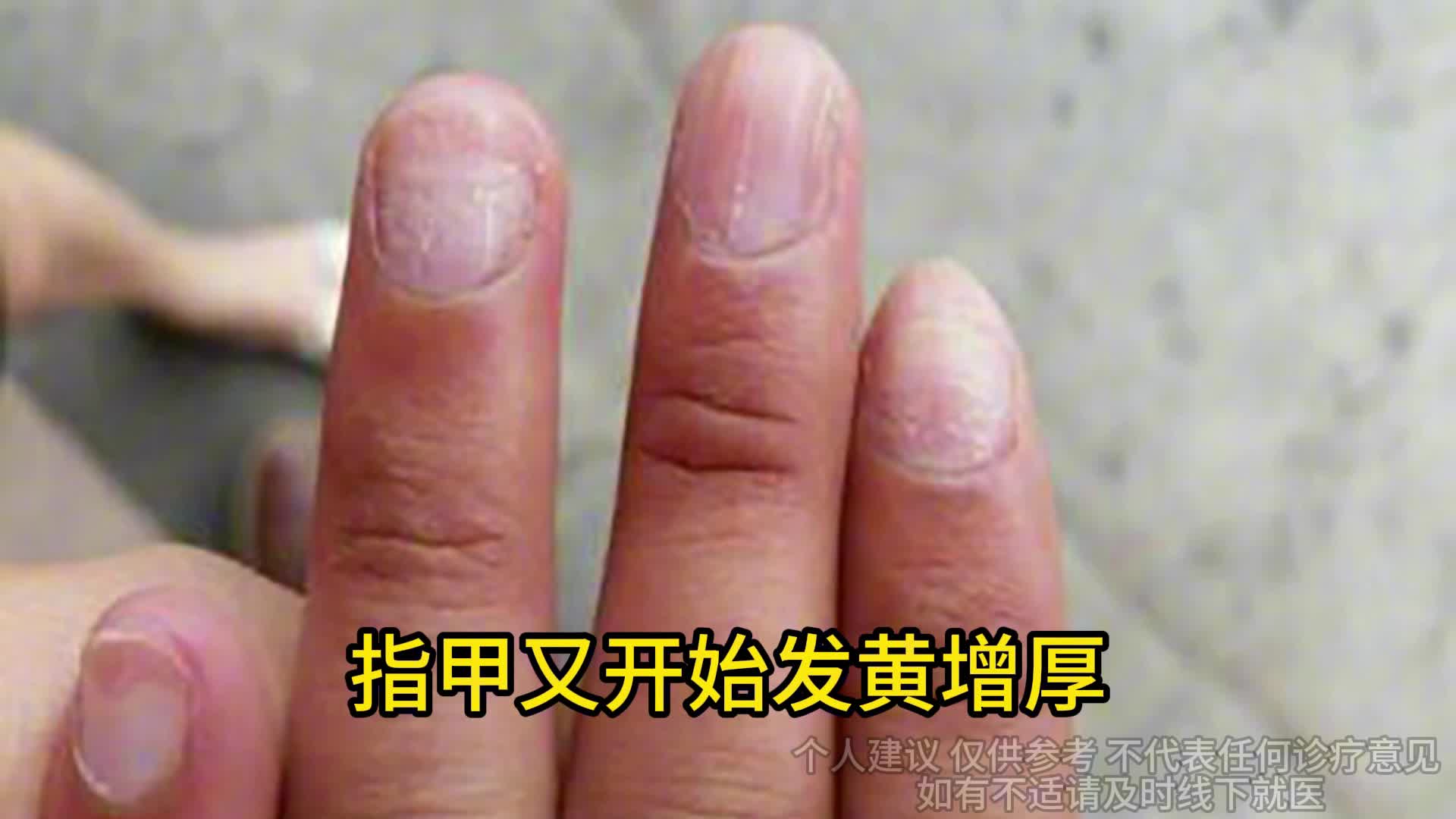 灰指甲成功上岸！经验：别拔甲，试试这个祛灰妙招！