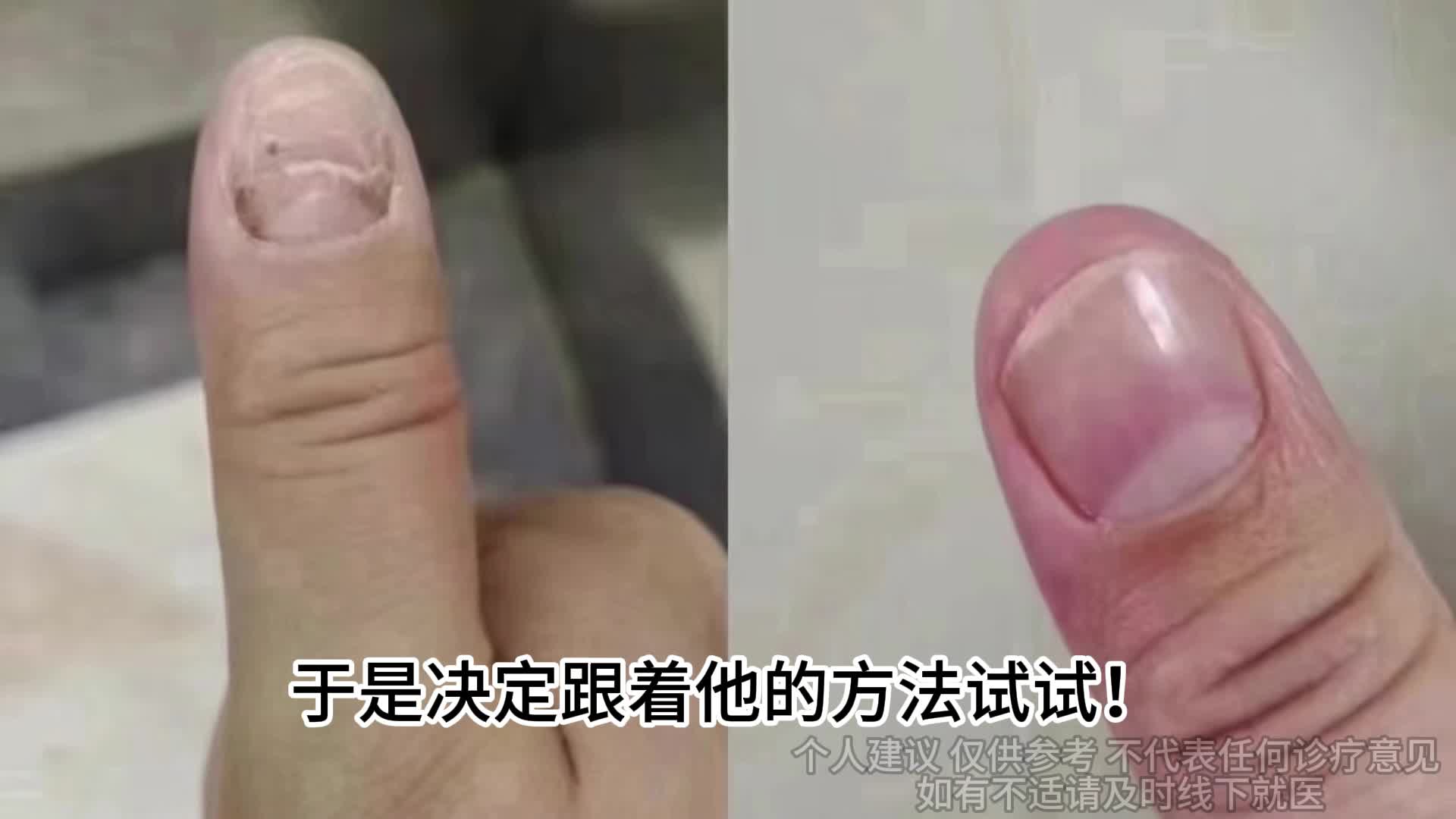 灰指甲康复者自述治疗经验！3天坏甲自动脱落！别再乱用偏方了！