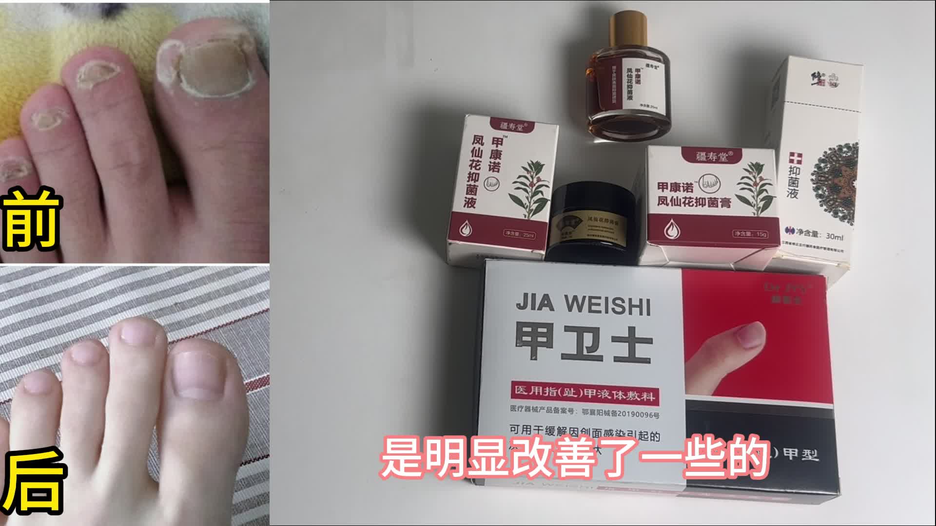 治疗灰趾甲别只知道用亮甲了！这几个效果更佳！便宜又好用！