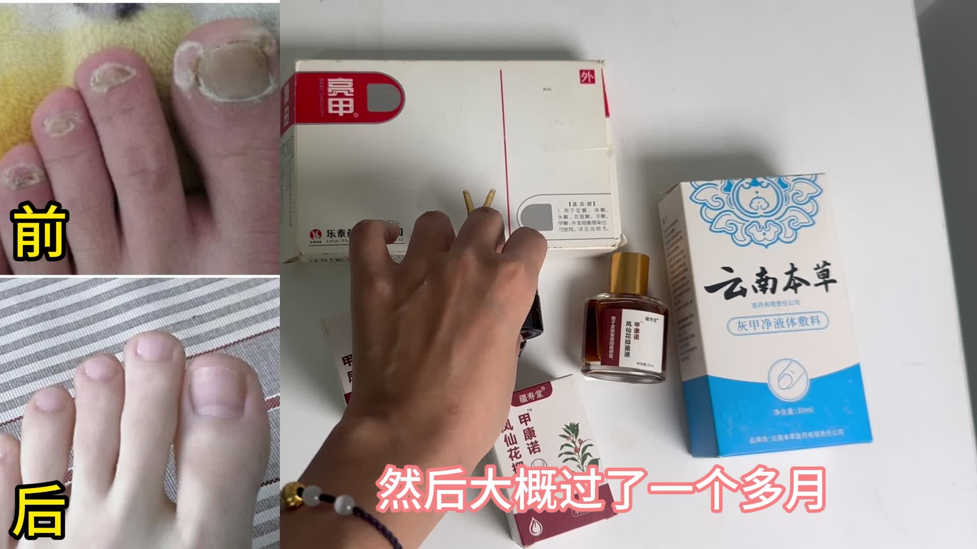 天一热灰趾甲又卷土重来？有这几个国货好物，在家给灰趾甲断根！