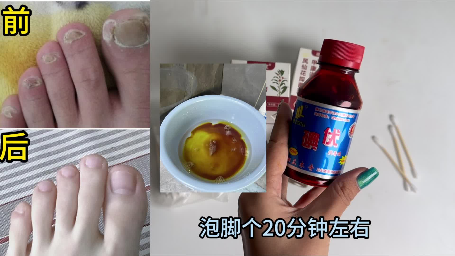 趾甲又厚又硬还发灰？别急，学会这招，不花一分冤枉钱在家根治！