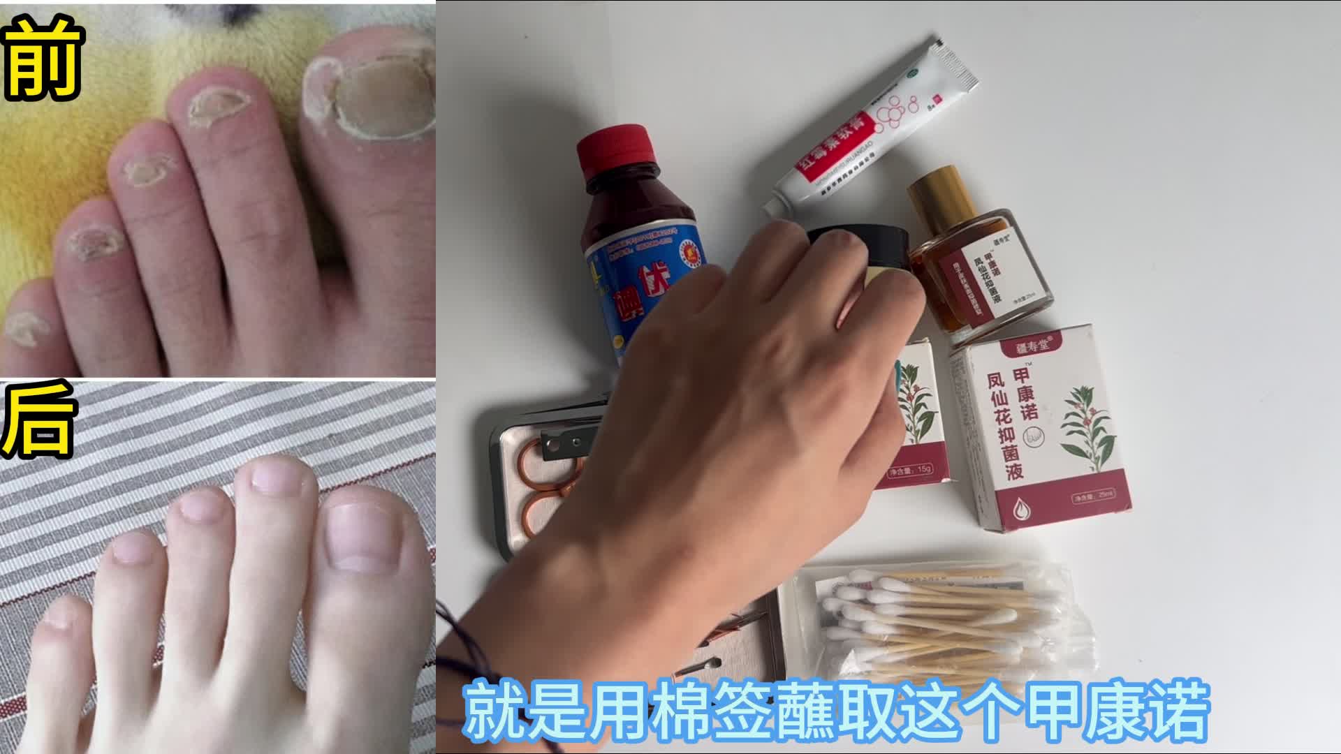 灰指甲到底怎么治？过来人自爆康复秘籍！原来只需简单4步！