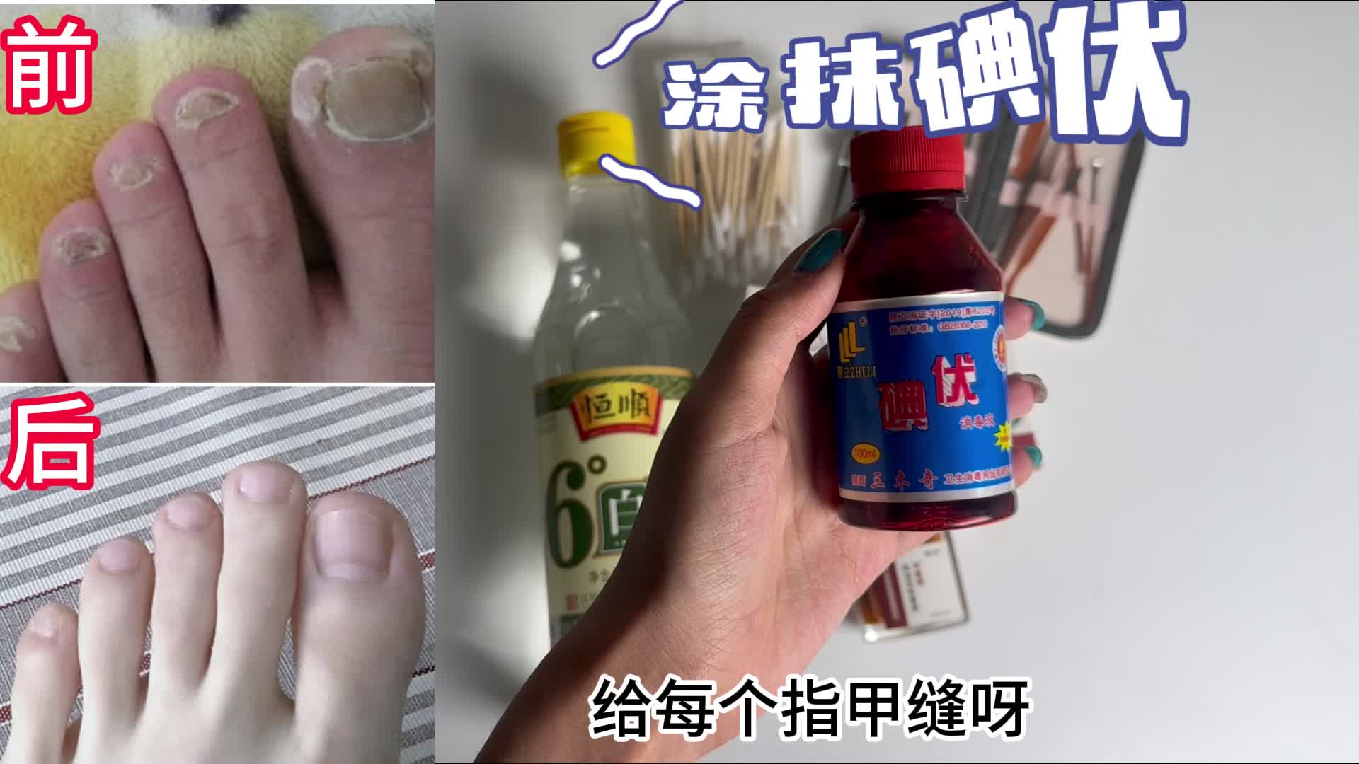 三年灰指甲成功根治！过来人经验分享，原来彻底除菌只需3步？！