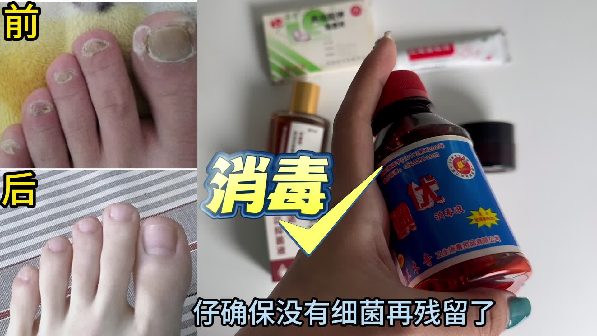灰指甲详细治疗方案曝光！原来真菌最怕它！学会省下一个亿！