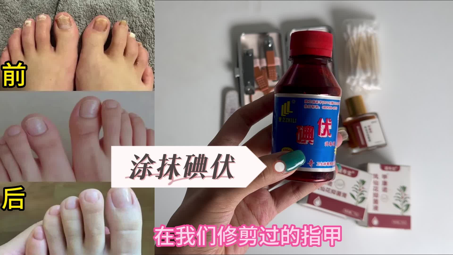 灰指甲别再乱治了！过来人亲测有效的妙招分享！在家分分钟摆脱！