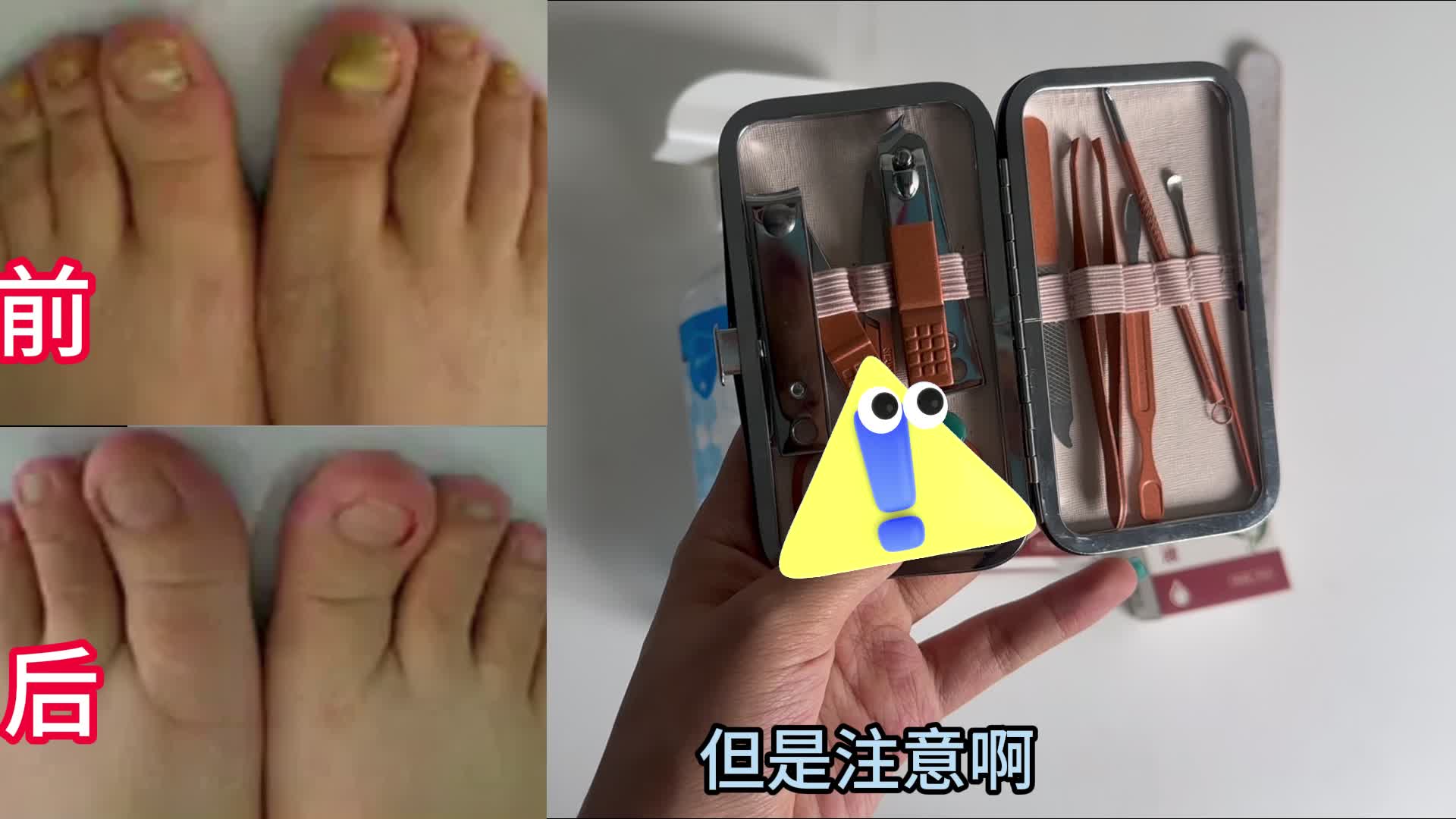 灰指甲怎么治才不复发？这几个治疗办法简单效果好，赶紧学学！