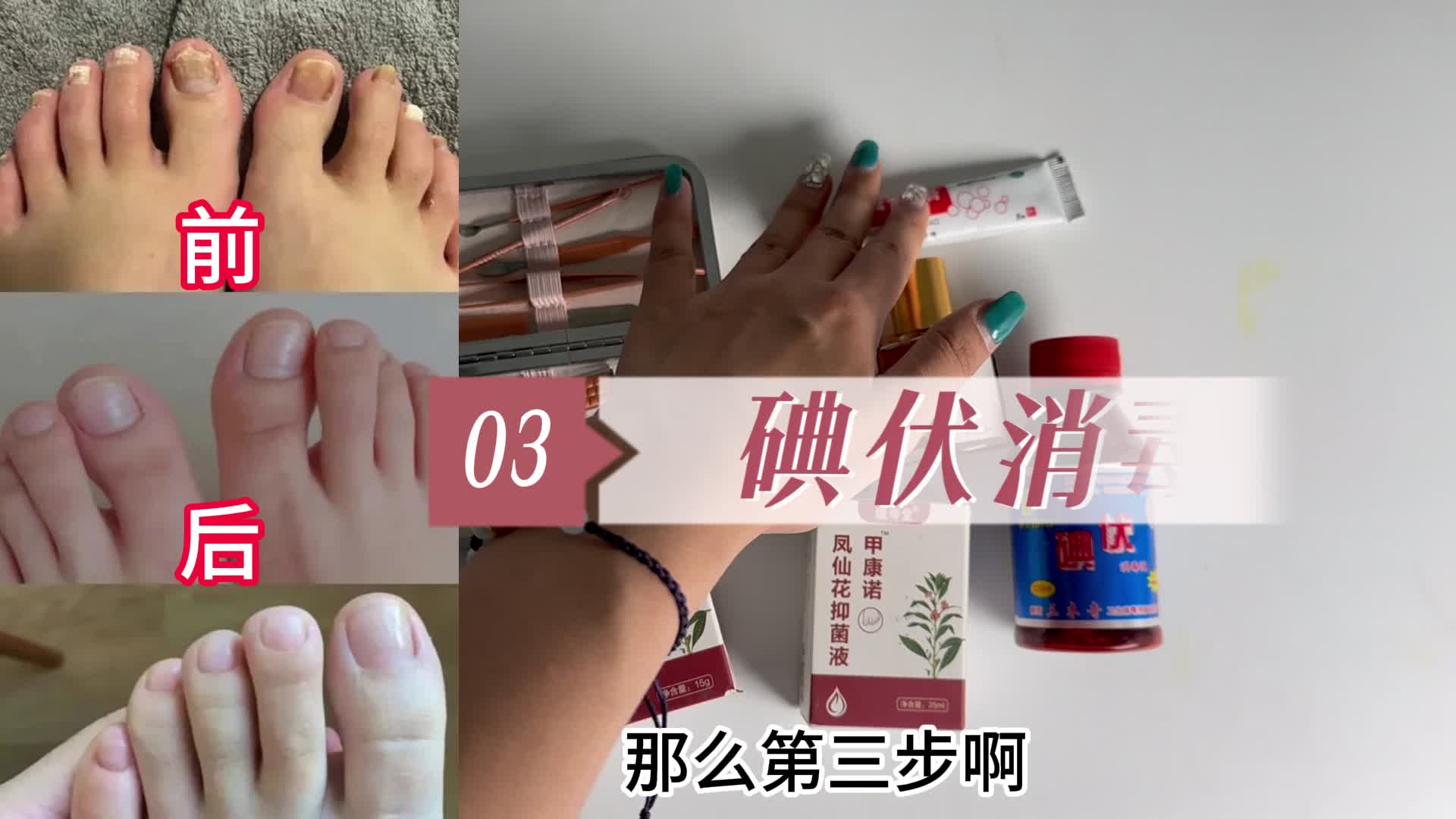 得了灰指甲到底怎么治？康复者分享自用妙招，坏甲秒变健康新甲！