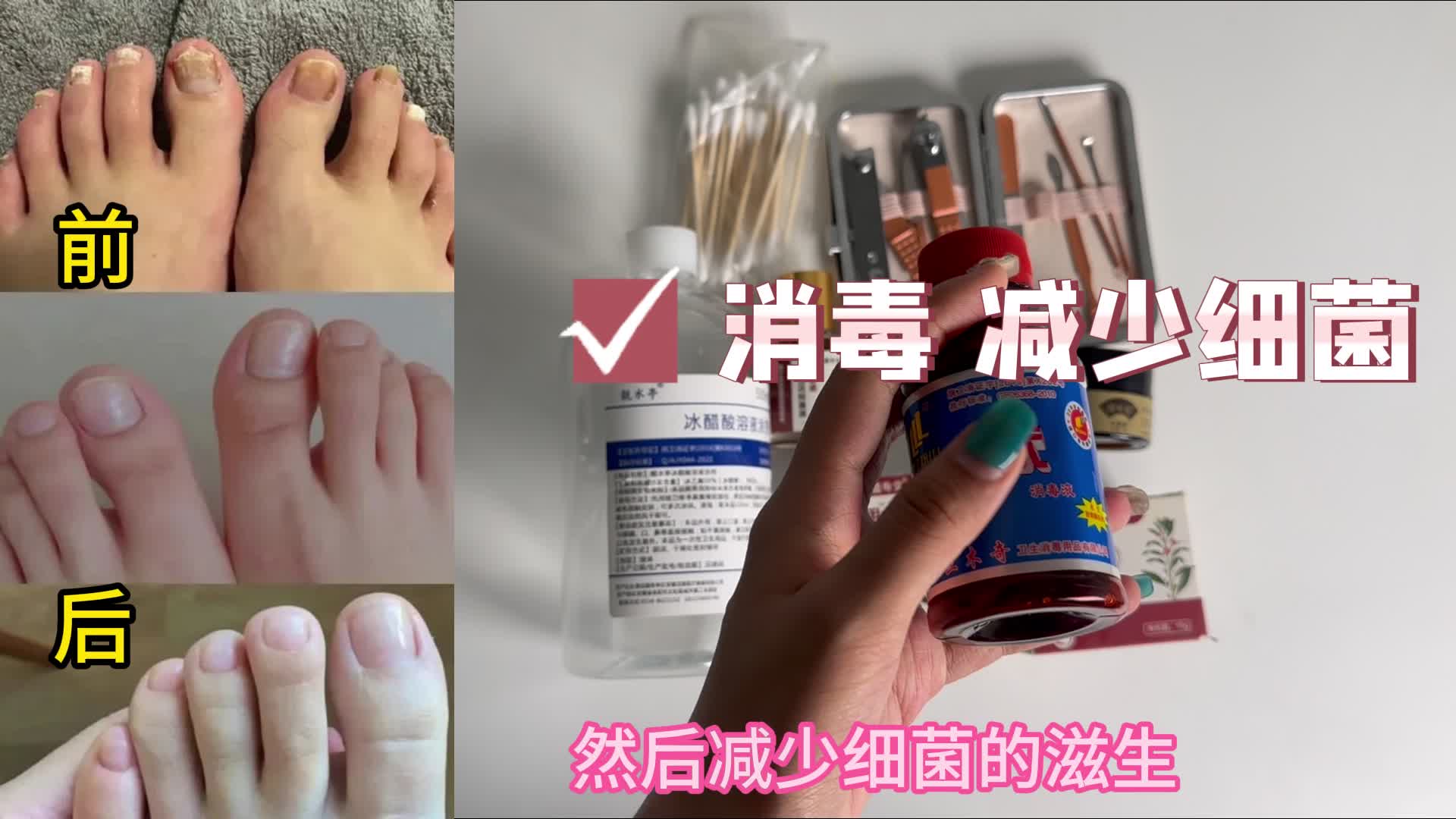 灰指甲如何根治不复发？有这个秘密武器，杀菌修复不在话下！