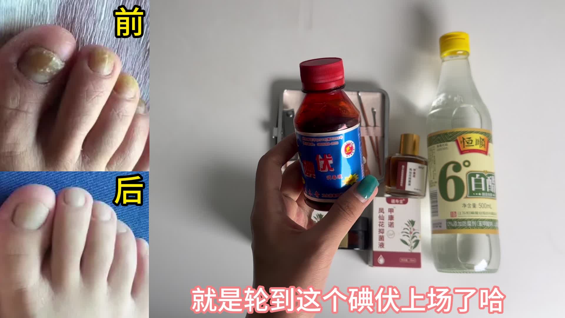 天热灰指甲真菌又作祟？学会这一招，在家一次性根治！