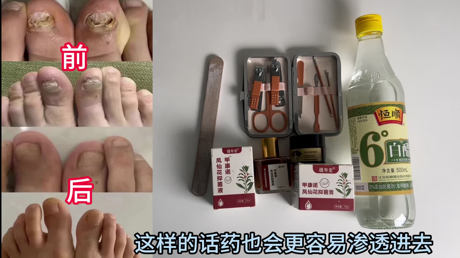 根治灰指甲的办法（亲测有效，本人灰指甲已好）