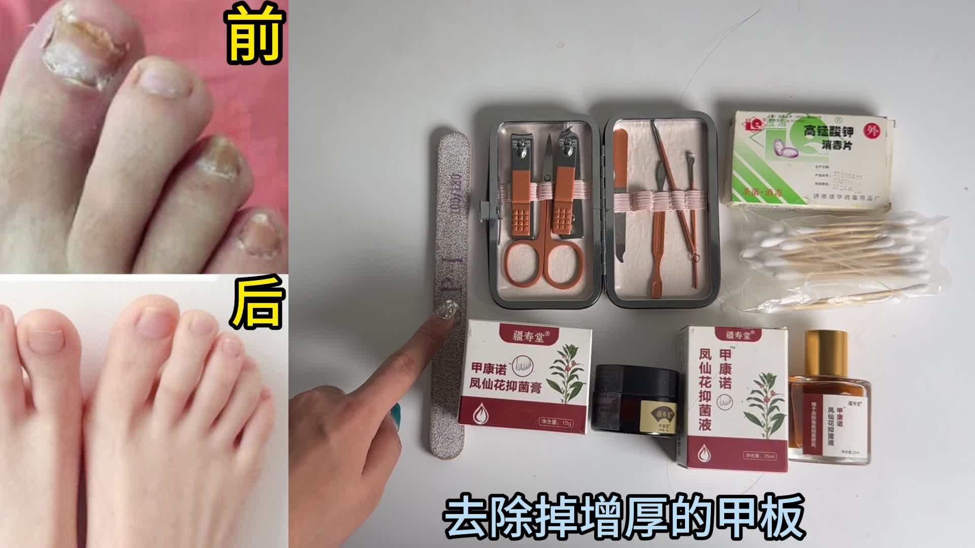 治疗灰指甲杀菌是关键！学会这两招！病甲变亮甲，真菌无处逃！