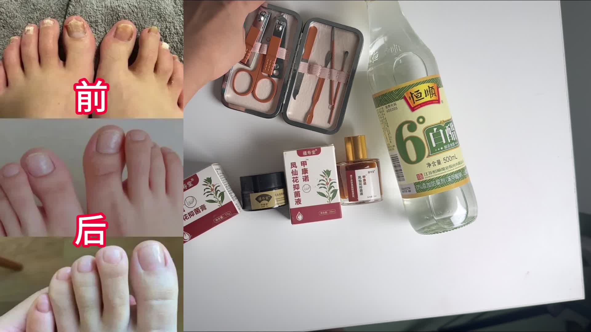 治疗灰指甲别再乱用偏方了！学会这招，顽固灰甲在家也能根除！