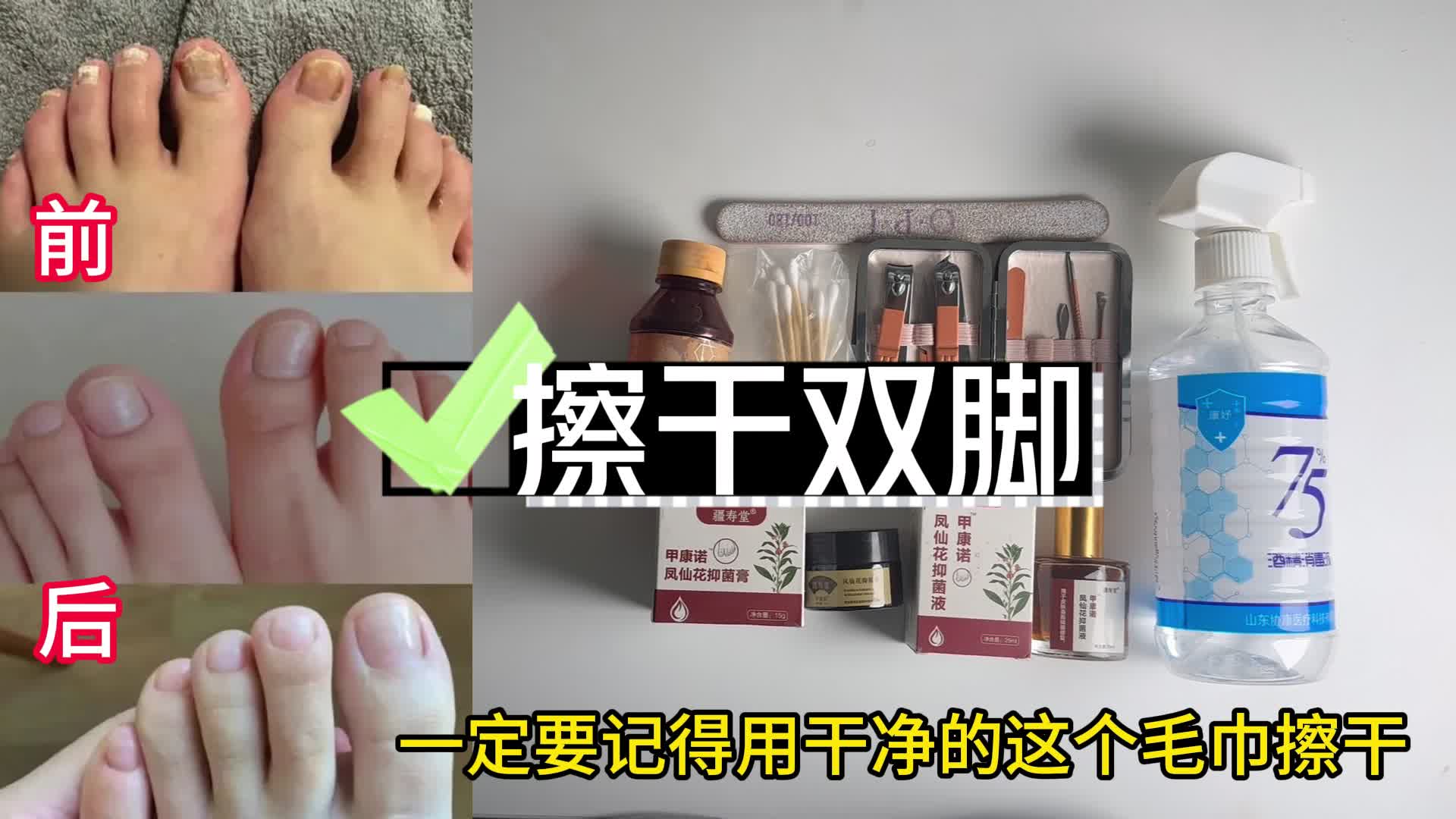 治灰指甲别再傻傻用偏方了！掌握核心步骤，顽固坏甲秒变新甲！