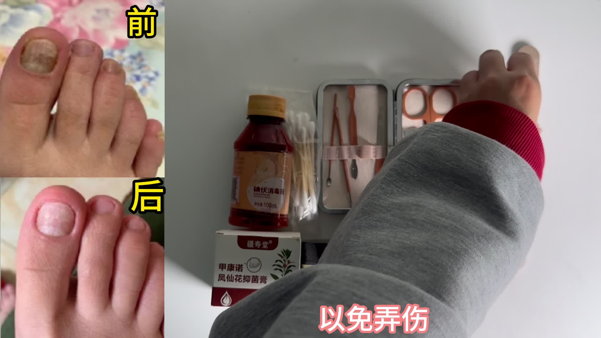 灰指甲别乱治了！过来人亲测有效的妙招分享！学会立省大几千！