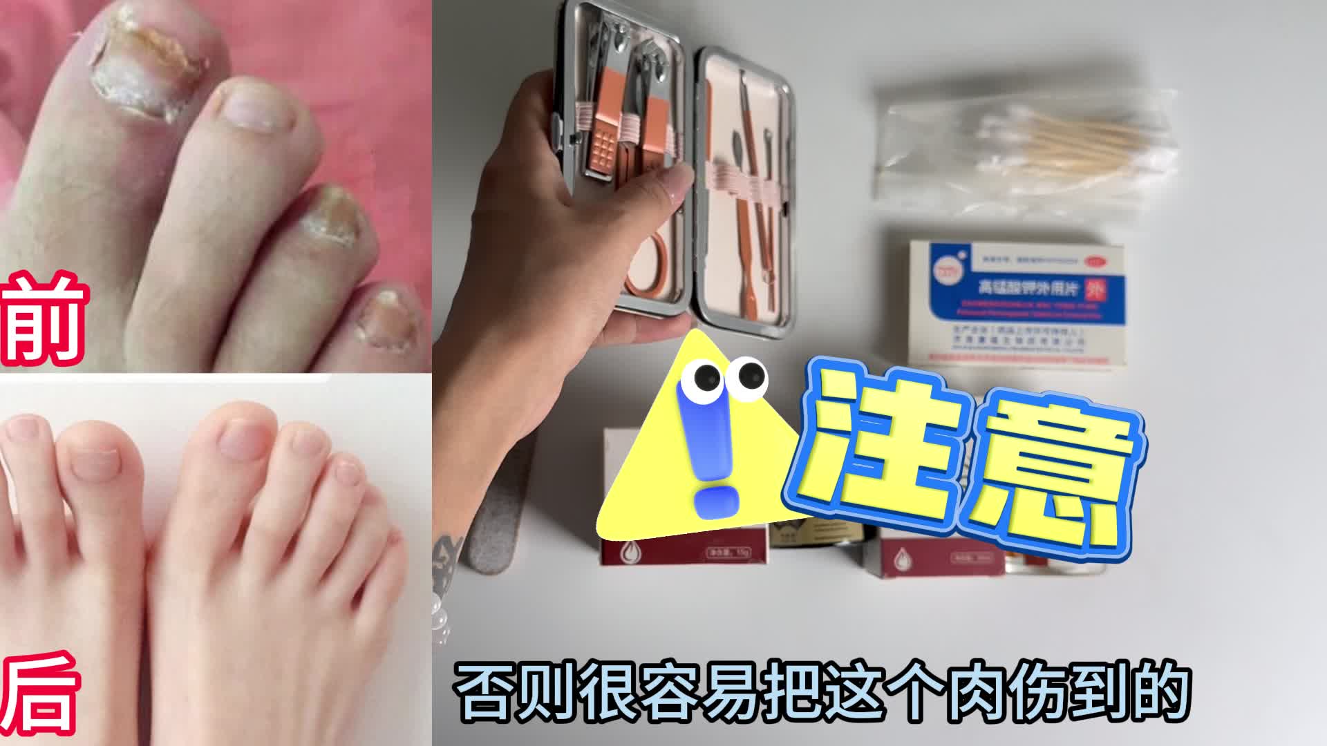多年灰指甲成功根治！这个详细步骤还有人不知道？祛灰绝了！