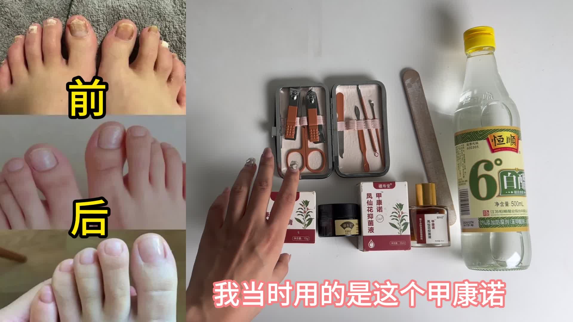 亲测有效的灰指甲根治方法分享！（详细步骤版）
