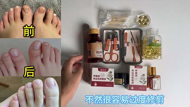 砸伤脚趾竟意外引起灰指甲！过来人一招在家根治！学会受益终身！