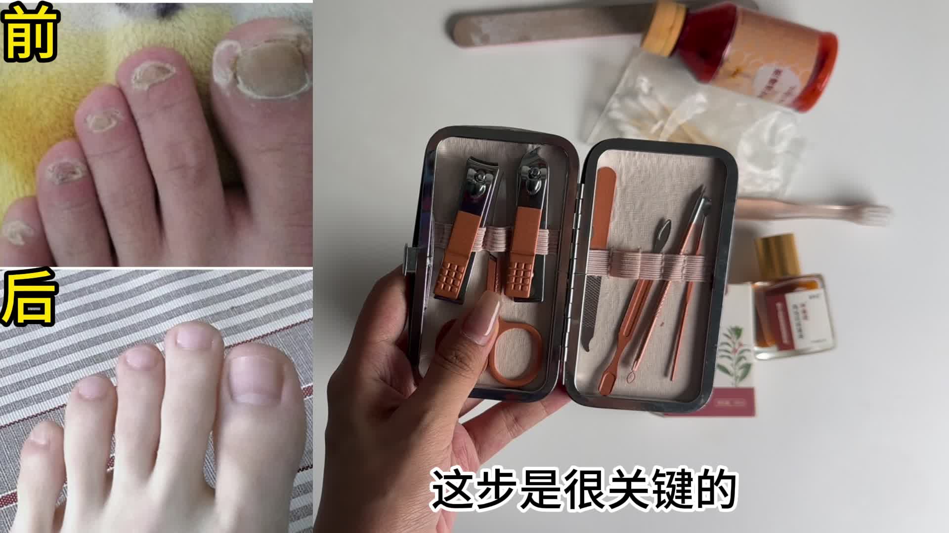 低成本祛灰方法分享！短短1个月，坏甲自动脱落！看到即赚到！