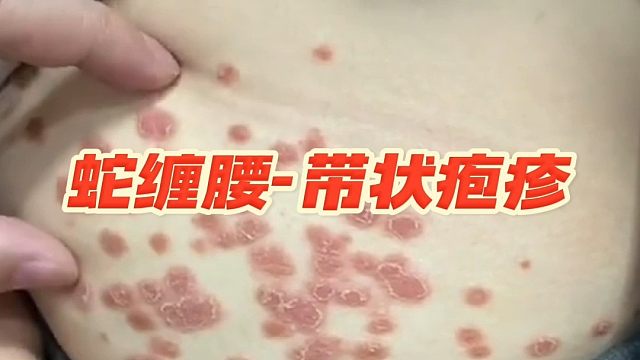 蛇缠腰要火爆头尾，免得窜远？