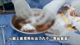 女人就因為喜歡烤肉吃生菜，心臟竟然長滿了蟲子，到底為何？