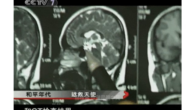 干细胞成功治愈脑中㶡七旬退休护士，重获自理能力