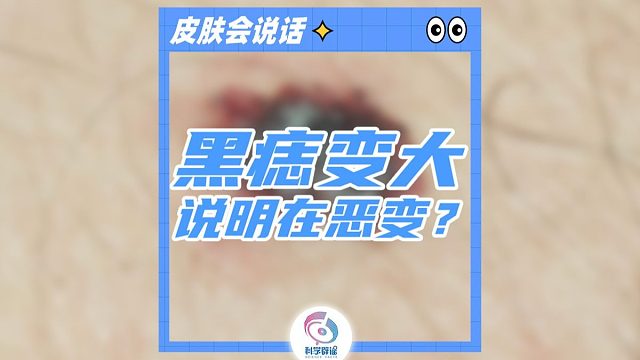 黑痣变大说明在恶变？