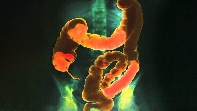 一个小伙子在6周里每天吃掉20根蛋白棒，这是他的结肠发生的变化