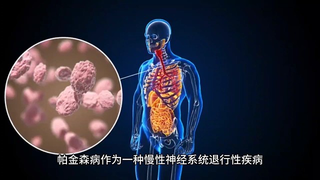 帕金森病作为一种慢性神经系统退行性疾病