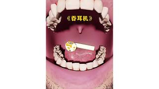 吞下了耳機(jī)應(yīng)該怎么辦？
