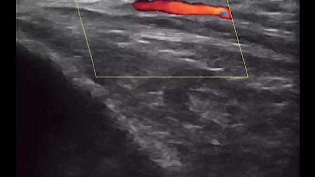 Ultrasound Guided Temple Augmentation