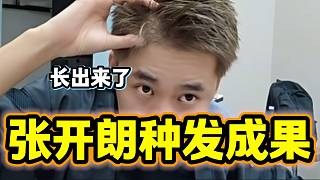 張開朗種完頭發(fā)后有明顯的效果，但是看起來還是有部分沒長出來！