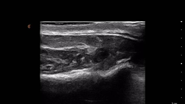 我是邱焕标，告诉大家蛙腮的原理，机制和处理。