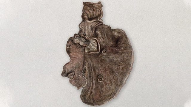 一个学生食用了从垃圾堆里捡来的加油站寿司，这是他的胃发生的变化