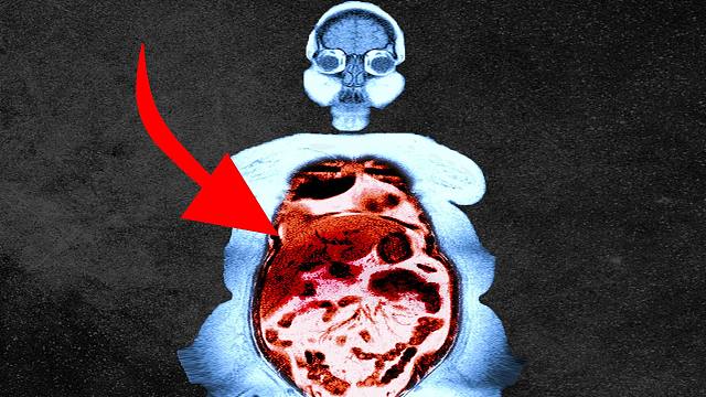 一位女性服用了朋友的司美格鲁肽，她的肠道是这样完蛋的